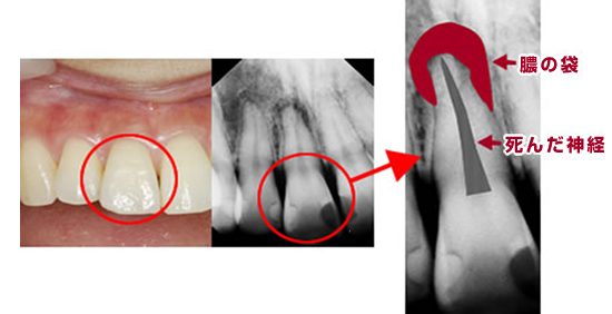 歯の神経の治療（根管治療）の治療例