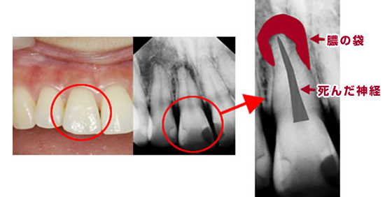 歯の神経の治療(根管治療)の治療例