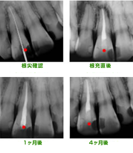 根尖確認後、リーマーと呼ばれる細長い器具を使って膿・死んだ神経を取り除く