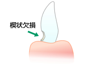 楔状欠損