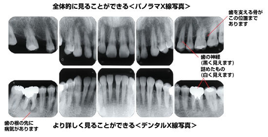 レントゲン写真