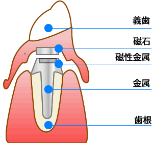 マグネットデンチャー（マグネットの入れ歯）