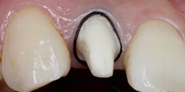 (3)【治療中】正確な歯型をとるため糸を巻く