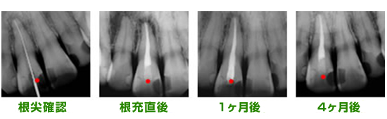 根尖確認後、リーマーと呼ばれる細長い器具を使って膿・死んだ神経を取り除く