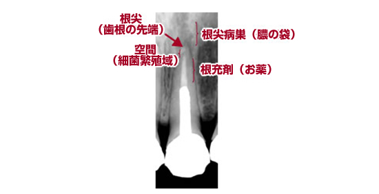 神経の治療が正確に行われていないと