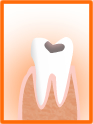 虫歯の進行2
