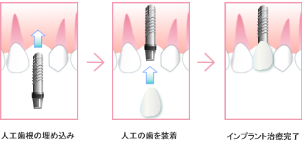 インプラントの仕組み