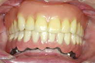 インプラント＋入れ歯の症例