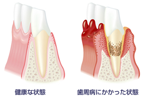 健康な状態と歯周病にかかった状態