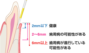 歯周ポケットの測定