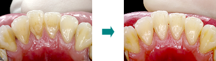 歯周病治療で改善した例