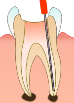 根管治療