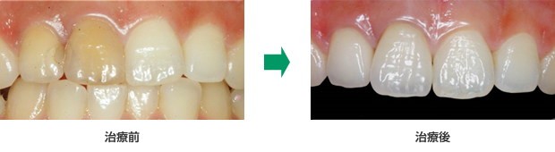 変色歯を、セラミック治療で白く整えた例