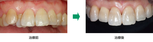 セラミッククラウンで歯並びを整えた例