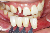 歯の色見本(シェードガイド)