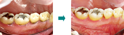 歯周病治療で改善した例