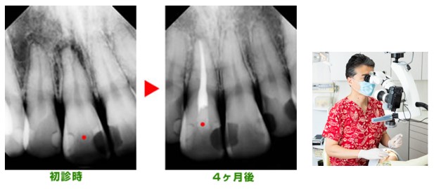 根管治療マイクロスコープ画像
